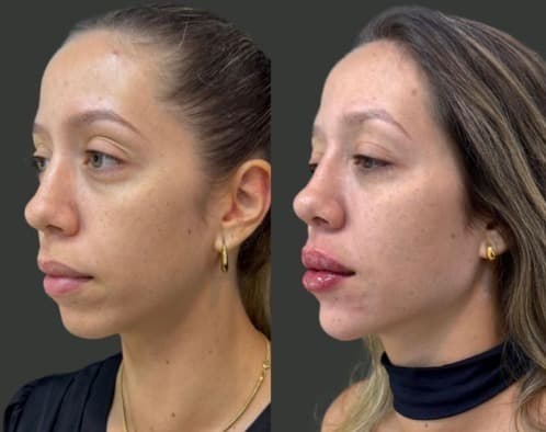 Perfil de uma cliente antes e depois do preenchimento, lado a lado